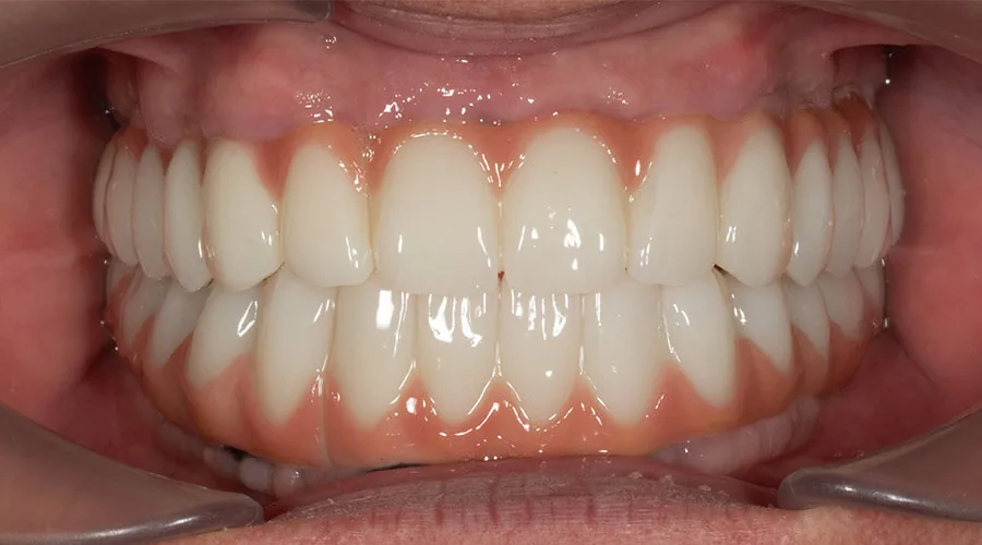 Full upper arch after All-on-4 treatment