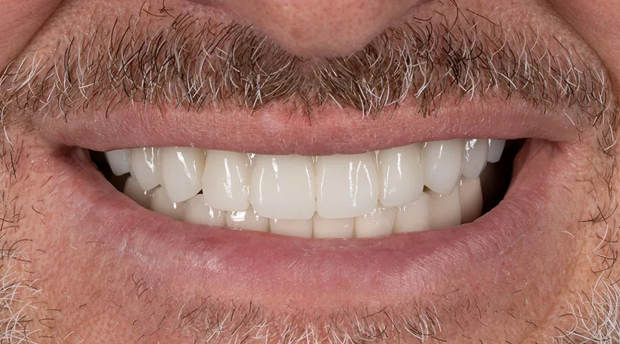 Full mouth restoration after treatment