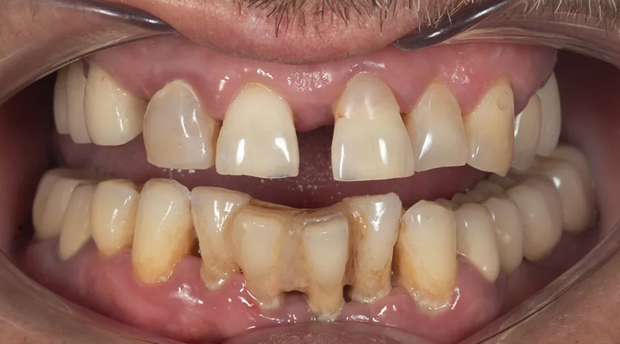 Full mouth restoration before treatment