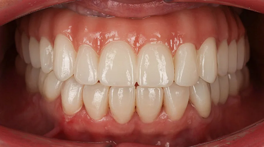 Single implant Straumann after treatment