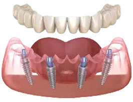 All-on-4 implant illustration