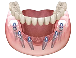 All-on-6 implant illustration
