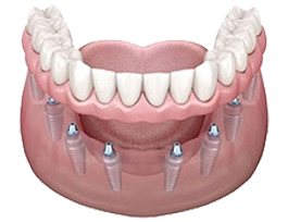 All-on-8 implant illustration